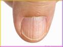 White marks on Nails: नखांवर पांढरे डाग दिसत आहेत? जाणून घ्या त्यामागील कारणं
