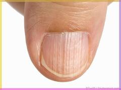 White marks on Nails: नखांवर पांढरे डाग दिसत आहेत? जाणून घ्या त्यामागील कारणं