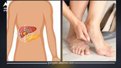 ਪੈਰਾਂ ਦੀ ਸੋਜ ਨੂੰ ਨਾ ਕਰੋ ਨਜ਼ਰਅੰਦਾਜ਼...ਲੀਵਰ ਦੇ ਖਰਾਬ ਹੋਣ ਵੱਲ ਸੰਕੇਤ!