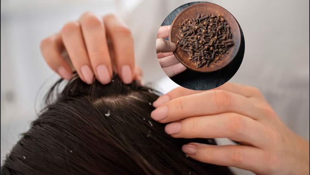 4 ਲੌਂਗ ਦੇ ਟੁਕੜੇ ਖਤਮ ਕਰਨਗੇ ਸਿੱਕਰੀ, ਤੁਰੰਤ ਅਜ਼ਮਾਓ ਇਹ ਨੁਸਖ਼ਾ, ਡੈਂਡਰਫ ਤੋਂ ਮਿਲੇਗਾ ਛੁਟਕਾਰਾ