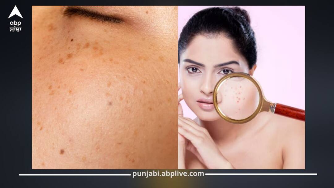ਸਾਵਧਾਨ! ਅਚਾਨਕ ਚਿਹਰੇ 'ਤੇ ਵੱਧ ਰਹੇ ਕਾਲੇ ਧੱਬੇ ਤਾਂ ਹੋ ਜਾਓ ਸਾਵਧਾਨ, ਕਿਤੇ ਇਸ ਬਿਮਾਰੀ ਦੇ ਤਾਂ ਨਹੀਂ ਹੋ ਗਏ ਸ਼ਿਕਾਰ