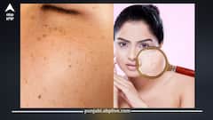 ਸਾਵਧਾਨ! ਅਚਾਨਕ ਚਿਹਰੇ 'ਤੇ ਵੱਧ ਰਹੇ ਕਾਲੇ ਧੱਬੇ ਤਾਂ ਹੋ ਜਾਓ ਸਾਵਧਾਨ, ਕਿਤੇ ਇਸ ਬਿਮਾਰੀ ਦੇ ਤਾਂ ਨਹੀਂ ਹੋ ਗਏ ਸ਼ਿਕਾਰ