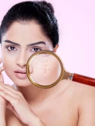 ਦਵਾਈਆਂ ਦੇ ਸਾਈਡ ਇਫੈਕਟ – ਕੁਝ ਦਵਾਈਆਂ (ਜਿਵੇਂ ਐਂਟੀਬਾਇਓਟਿਕ ਜਾਂ ਹਾਰਮੋਨਲ ਗੋਲੀਆਂ) ਨਾਲ ਵੀ ਸਕਿਨ 'ਤੇ ਡਾਰਕ ਸਪਾਟ ਆ ਸਕਦੇ ਹਨ। ਹੋਰ ਕਾਰਣ – ਜਲਣ, ਜਾਨਵਰ ਦੇ ਕੱਟਣ ਜਾਂ ਕਿਸੇ ਕ੍ਰੀਮ/ਸਕਿਨ ਪ੍ਰੋਡਕਟ ਦੇ ਰਿਐਕਸ਼ਨ ਨਾਲ ਵੀ ਚਮੜੀ 'ਤੇ ਧੱਬੇ ਪੈ ਸਕਦੇ ਹਨ।  ਇਹ ਧੱਬੇ ਅਕਸਰ ਚਿਹਰੇ, ਬਾਂਹਾਂ ਅਤੇ ਉਨ੍ਹਾਂ ਹਿੱਸਿਆਂ 'ਤੇ ਦਿਖਦੇ ਹਨ ਜਿੱਥੇ ਸੂਰਜ ਦੀ ਰੋਸ਼ਨੀ ਵੱਧ ਪੈਂਦੀ ਹੈ।