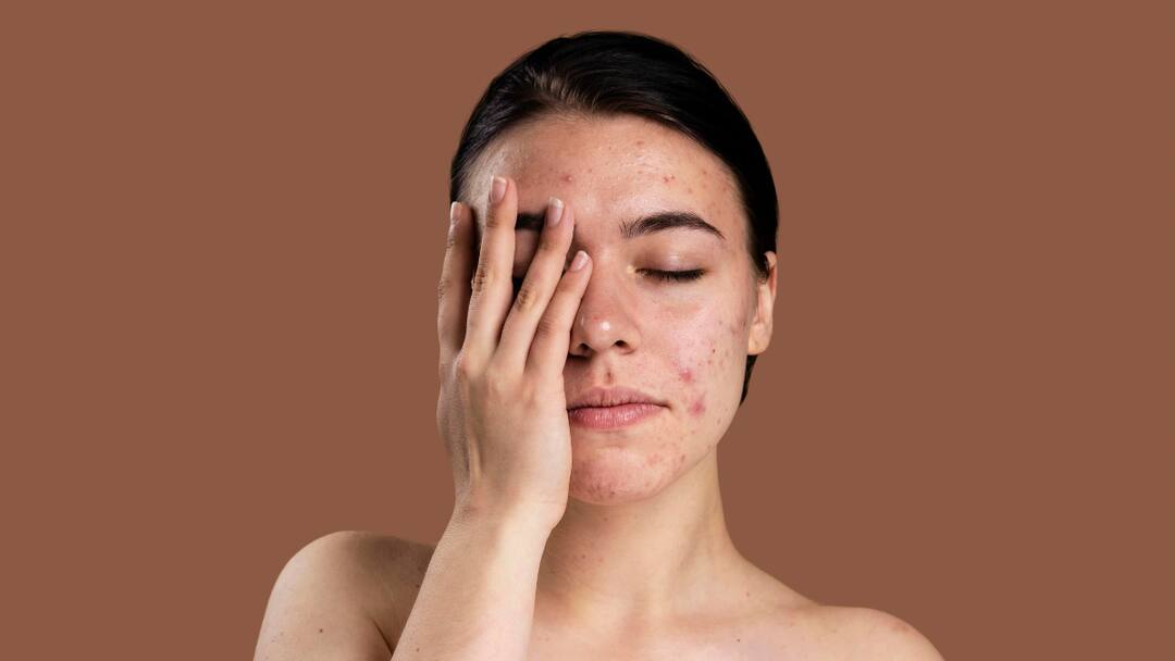 8 Common Acne Myths You Need To Stop Believing 8 Common Acne Myths You Need To Stop Believing