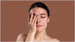 మొటిమలపై అపోహలు, నిజాలేంటి? నిపుణుల సలహాలతో పింపుల్స్​కి చెక్ పెట్టండిలా