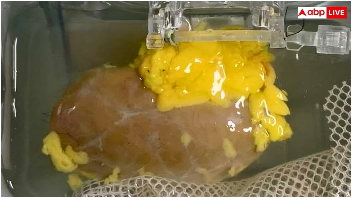 Universal Kidney: अब नहीं रुकेगा किसी भी ब्लड ग्रुप के मरीज का किडनी ट्रांसप्लांट, वैज्ञानिकों ने बना ली यूनिवर्सल किडनी