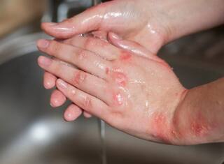 Diwali 2025: ફટાકડાથી દાઝી ગયા બાદ ભૂલથી પણ ન લગાવો આ ચીજ, નહિતો થશે ગંભીર સ્થિતિ