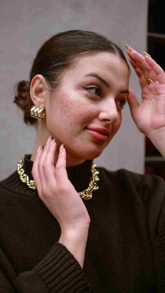 बार-बार स्किन पर क्यों हो जाता है पिग्मेंटेशन?