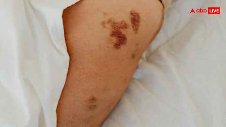 अगर आपकी स्किन के कुछ हिस्से जैसे गर्दन के पीछे, बगलों या कमर पर गहरे या वेलवेट जैसे पैच दिखने लगे हैं तो ये सिर्फ स्किन प्रॉब्लम नहीं, बल्कि आपके शरीर में इंसुलिन रेजिस्टेंस का अलार्म है. इसे मेडिकल भाषा में Acanthosis Nigricans कहते हैं और यह PCOS से सीधा जुड़ा हुआ होता है. इन पैचेज को नजरअंदाज न करें. ये शुगर और हार्मोन दोनों के इंबैलेंस की निशानी हो सकते हैं.