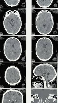 7 Early Symptoms Of Brain Tumours You Should Never Ignore