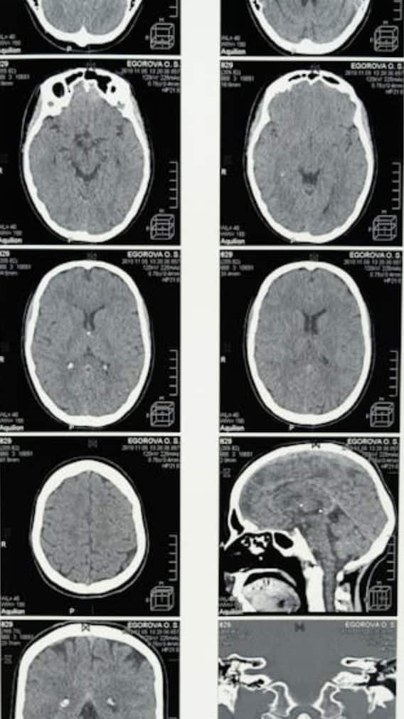 7 Early Symptoms Of Brain Tumours You Should Never Ignore