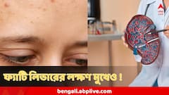ফ্যাটি লিভারের পর্যায় আরও খারাপ হচ্ছে ! মুখেই দেখা যাবে এসব লক্ষণ