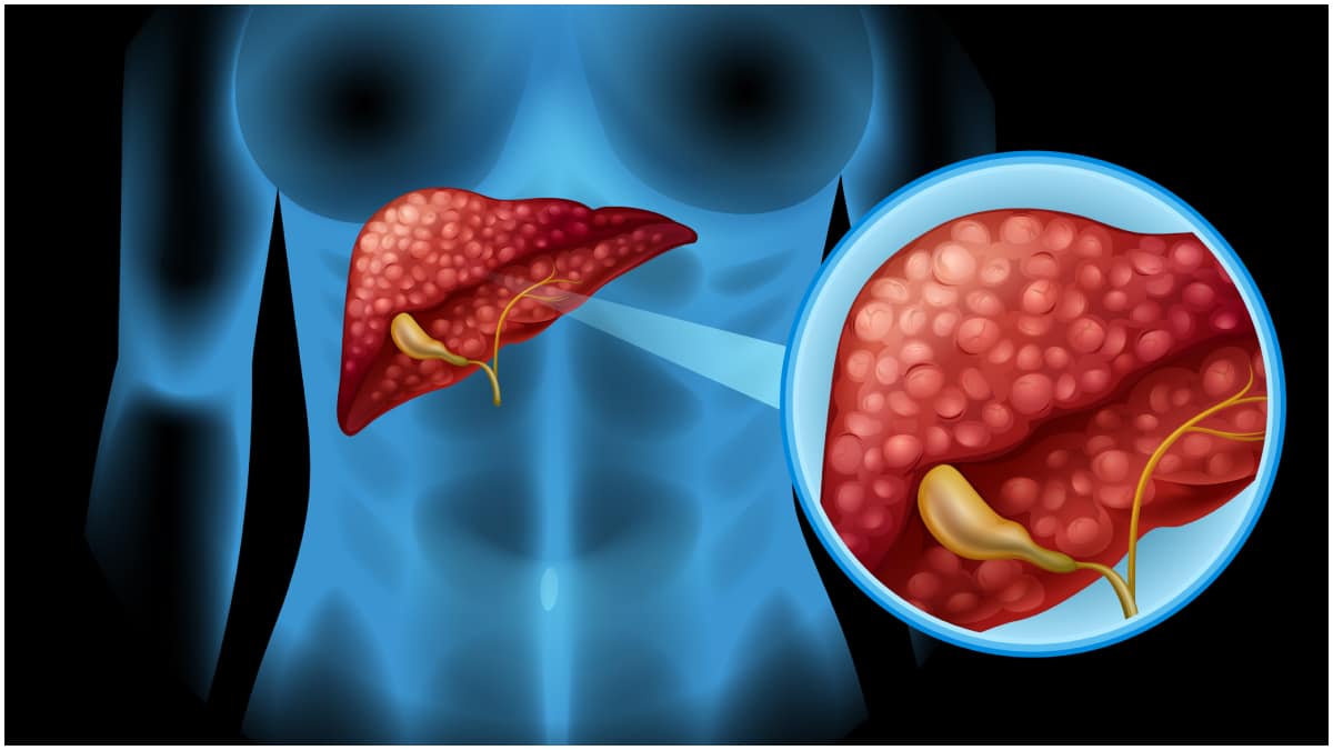 Liver Cirrhosis : కాలేయ సిరోసిస్​తో క్యాన్సర్ ప్రమాదం.. ఏ దశలో రోగి చనిపోయే ప్రమాదం ఉందో తెలుసా?