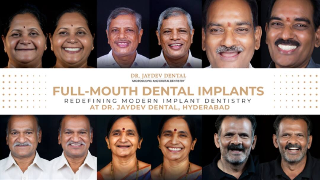 Full-Mouth Dental Implants in One Day — Dr. Jaydev Redefines Modern Dentistry Full-Mouth Dental Implants in One Day — Dr. Jaydev Dental, Clears the Myths Around Modern Implant Dentistry