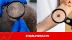চুল পাকছে বলে দুঃখের শেষ নেই? বড় বাঁচা বেঁচে গেলেন হয়ত! ত্বকের ক্যান্সারের গবেষণায় চমকপ্রদ তথ্য