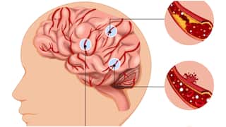 World Stroke Day : ప్రపంచ స్ట్రోక్ డే.. FAST టెస్ట్ అంటే ఏమిటి? స్ట్రోక్ రాకుండా తీసుకోవాల్సిన జాగ్రత్తలివే