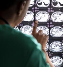 Symptoms of brain tumor : फक्त डोकेदुखी की गंभीर आजार? ब्रेन ट्यूमरची 'ही' लक्षणं तुम्हाला नाही ना?