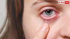 फोन-लैपटॉप का हद से ज्यादा इस्तेमाल खतरनाक, युवाओं में तेजी से बढ़ रही ड्राई आइज की प्रॉब्लम