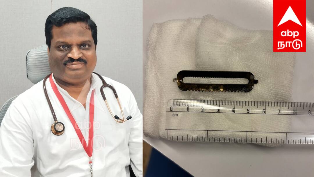 விழுப்புரம் மருத்துவமனையில் அதிசயம்! வயிற்றில் சிக்கிய 5.5 செ.மீ ஸ்டீலை அறுவை சிகிச்சை இன்றி அகற்றி சாதனை! Villupuram Hospital Record-breaking removal of 5.5 cm steel stuck in stomach without surgery tnn விழுப்புரம் மருத்துவமனையில் அதிசயம்! வயிற்றில் சிக்கிய 5.5 செ.மீ ஸ்டீலை அறுவை சிகிச்சை இன்றி அகற்றி சாதனை!