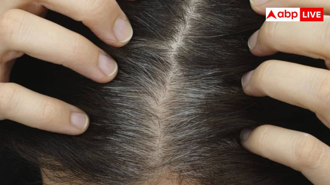 कुछ लोगों के बचपन से ही सफेद क्यों होने लगते हैं बाल, शरीर में इन विटामिन्स की हो सकती है कमी कुछ लोगों के बचपन से ही सफेद क्यों होने लगते हैं बाल, शरीर में इन विटामिन्स की हो सकती है कमी