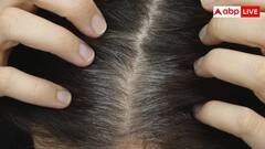 कुछ लोगों के बचपन से ही सफेद क्यों होने लगते हैं बाल, शरीर में इन विटामिन्स की हो सकती है कमी