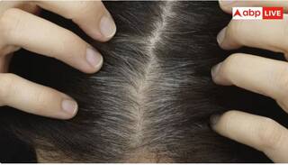ਕੁਝ ਲੋਕਾਂ ਦੇ ਬਚਪਨ ਤੋਂ ਹੀ ਚਿੱਟੇ ਕਿਉਂ ਹੋ ਜਾਂਦੇ ਨੇ ਵਾਲ ? ਜਾਣੋ ਇਸ ਪਿੱਛੇ ਦਾ ਅਸਲ ਕਾਰਨ