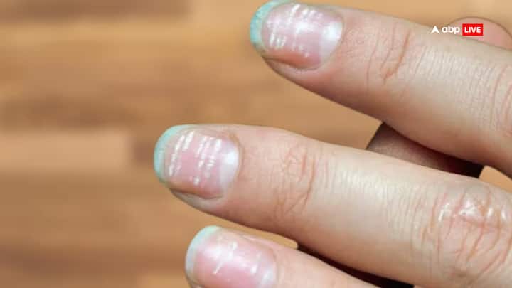 नाखुन खुरदुरे हैं तो इसका अर्थ लड़की का स्वभाव तनावग्रस्त और मन असंतोष से भरा है. नाखून पर सफेद दाग का होना शुभ संकेत माना जाता है.