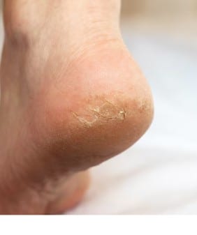 ਫੱਟੀਆਂ ਅੱਡੀਆਂ ਲਈ ਨਾਰੀਅਲ ਤੇਲ ਦੇ ਅਦਭੁਤ ਫਾਇਦੇ