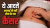 Signs of Stomach Cancer: पेट के कैंसर से बचना है तो बदलें ये डेली हैबिट्स, डॉक्टरों ने दी सलाह