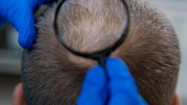 মাথার একেবারে উপরের অংশ, যাকে ‘ক্রাউন’ বলা হয়, সেখানকার চুল পাতলা হতে শুরু করলে বুঝবেন টাক পড়ার যথেষ্ট সম্ভাবনা রয়েছে। বেশির ভাগ মানুষের ক্ষেত্রে ওই জায়গাতেই টাক পড়ে প্রথমে।