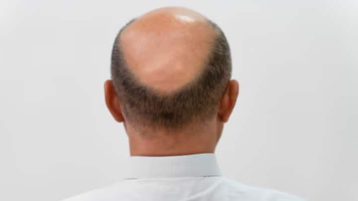 বিশেষ করে মধ্য ২০-তে টাক পড়ার লক্ষণ বোঝা সম্ভব। এক্ষেত্রে কিছু বিষয় লক্ষ্য় করতে হবে পুরুষদের। সেই মতো পদক্ষেপ করলে বিপদ কিছুটা অন্তত ঠেকানো সম্ভব হবে।