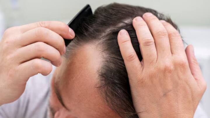 সিঁথি যদি ক্রমশ চওড়া হতে শুরু করে, তাহলেও উদ্বেগের যথেষ্ট কারণ রয়েছে। মহিলাদের মধ্যে বিশেষ করে টাক পড়ার ইঙ্গিত হয় সিঁথি চওড়া হয়ে যাওয়ার মধ্যেই।