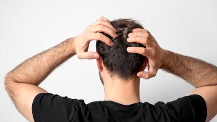 মাথার একটি জায়গা বার বার চুলকায়? সেখানে চুল ফাঁকা হয়ে যাচ্ছে? এক্ষেত্রে সূর্যের অতিবেগুনি রশ্মিই দায়ী। তরল বা পাওডার সানস্ক্রিন লাগাতে পারেন।