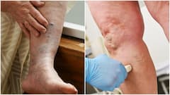 కాళ్లల్లో నరాలు ఉబ్బిపోవడానికి కారణాలు ఇవే.. అశ్రద్ధ చేస్తే ఆ ప్రమాదాలు తప్పవట, చికిత్స ఇదే