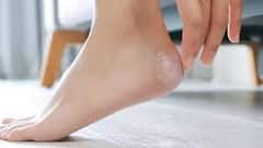Cracked Heels Remedy : આ સરળ પદ્ધતિથી ફાટેલી એડીઓથી છૂટકારો મેળવો!