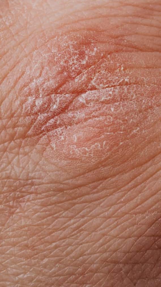 5 Effective Home Remedies To Treat Dry Skin Naturally