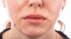 Dry Skin Remedies : हिवाळ्यात कोरडी त्वचा आणि फाटलेले ओठ टाळण्याचा सोपा उपाय!