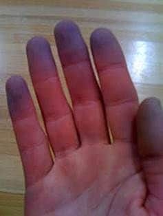 बाहेरून थंड झालेले हात आणि पाय लगेच गरम करू नका, कारण अचानक उब दिल्याने सूज आणि वेदना वाढू शकतात त्याऐवजी ब्लँकेट, मोजे किंवा हळूहळू उब देणाऱ्या इतर उपायांचा वापर करून हळूहळू गरम करणे अधिक सुरक्षित आणि आरामदायक असते.