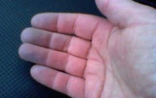 अत्यंत थंड पाण्यात भांडी धुणे किंवा कपडे धुणे यामुळे सूज वाढू शकते, त्यामुळे शक्य असल्यास नेहमी कोमट किंवा किंचित उबदार पाणी वापरावे.