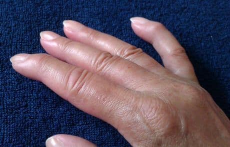 सतत अनवाणी चालणे, पाय थेट थंड जमिनीस संपर्कात येणे किंवा दीर्घकाळ थंडीत राहणे यामुळे ही समस्या आणखी वाढते.