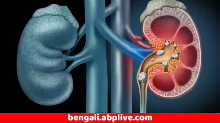 Kidney Stone Solution : শীতকালে ঠান্ডা থাকার কারণে জল কম পান করা হয়, যা কিডনির জন্য ক্ষতিকর।