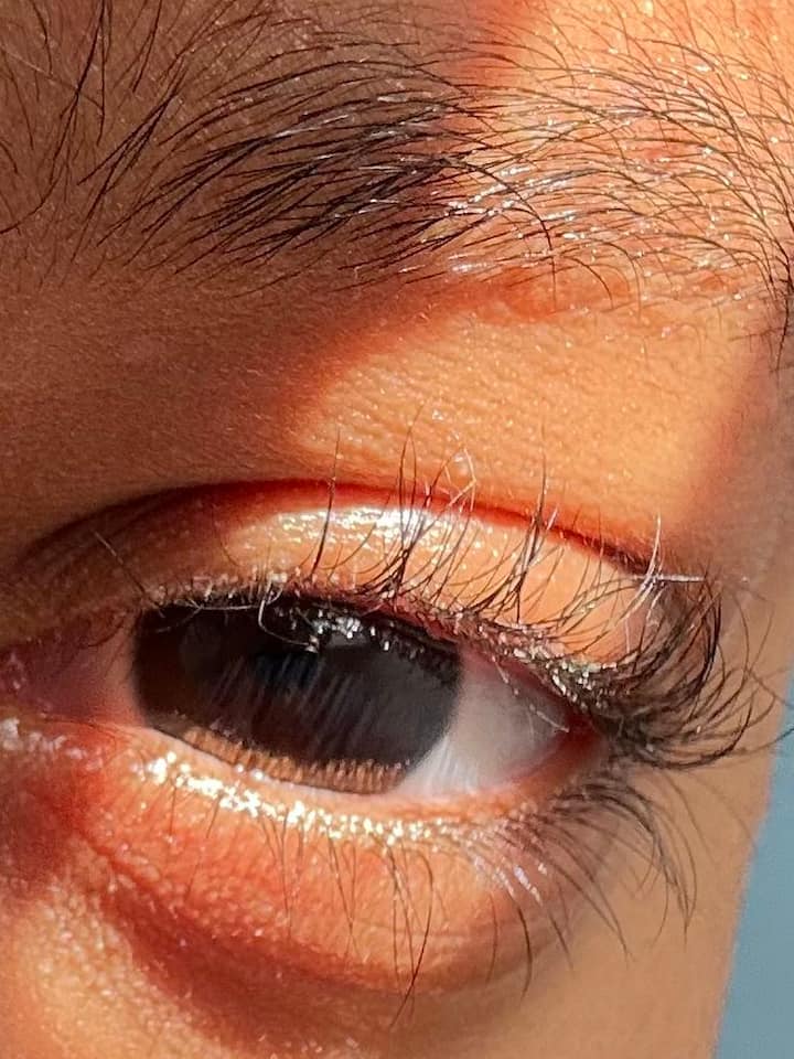 চক্ষু বিশেষজ্ঞের পরামর্শ ছাড়া কোনও ওষুধ বা আইড্রপ ব্যবহার করবেন না।