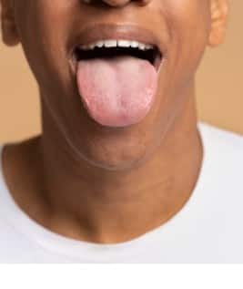 জিভ সাদা হয়ে যাচ্ছে? বিপদের লক্ষণ নয় তো?