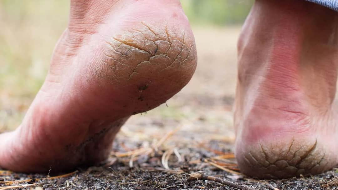 Cracked Heels: பனிக்காலத்தில் அதிகரிக்கும் குதிகால் வெடிப்பு.. சரி செய்ய ஈஸி டிப்ஸ் இதோ!