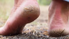 Cracked Heels: பனிக்காலத்தில் அதிகரிக்கும் குதிகால் வெடிப்பு.. சரி செய்ய ஈஸி டிப்ஸ் இதோ!