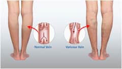కాళ్లల్లో నరాలు ఉబ్బడానికి కారణాలు ఇవే..  ఈ వెరికోస్ వెయిన్స్​కి చికిత్స ఉందా?