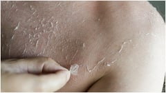 చర్మంపై పొడిబారిన, తెల్లని మచ్చలు కనిపిస్తున్నాయా? ఈ ఇంటి చిట్కాలతో దూరం చేసుకోండి