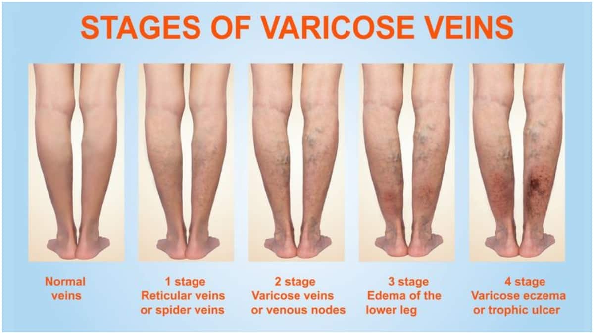 Varicose Veins : కాళ్లల్లో నరాలు ఉబ్బడానికి కారణాలు ఇవే..  ఈ వెరికోస్ వెయిన్స్​కి చికిత్స ఉందా?