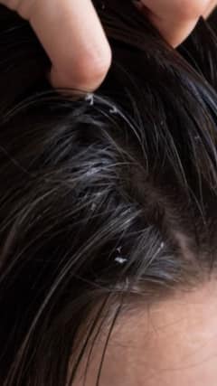 শুধু খুশকি নয়, চোকলা উঠছে মাথা থেকে? সস্তার নিরাময় হাতের কাছেই