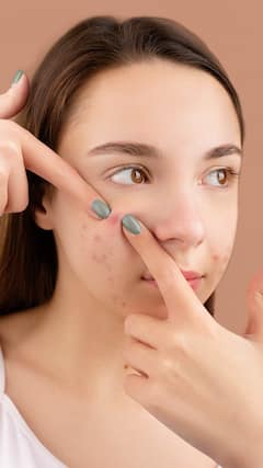 పింపుల్స్ తగ్గించే ఇంటి చిట్కాలు